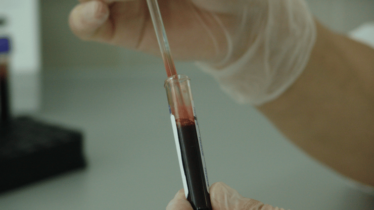 Acquired Immune Deficiency Syndrome nursing case study
