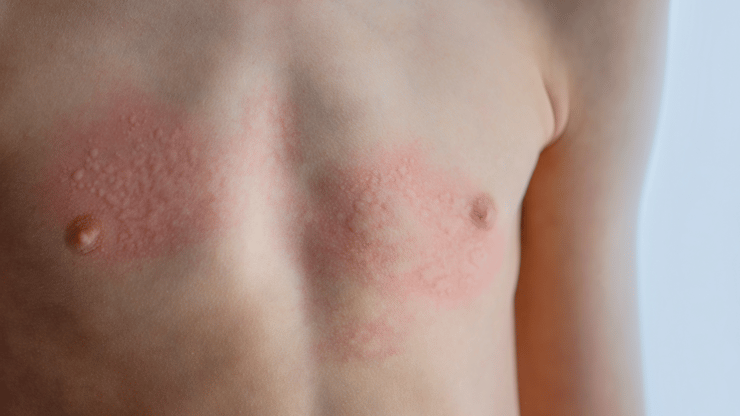 Anaphylaxis nclex prep