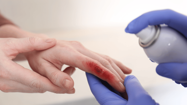 Burn Injuries nclex review (1)-1