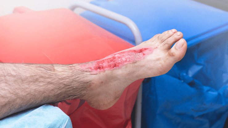 Burn Injuries nclex review