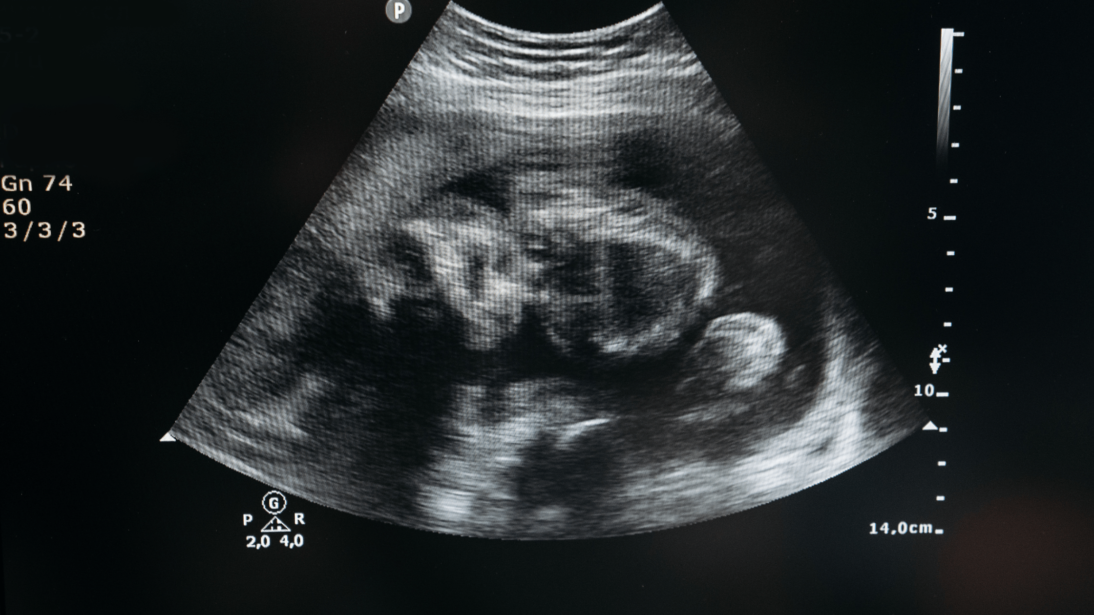 Chorioamnionitis nclex prep nursing student