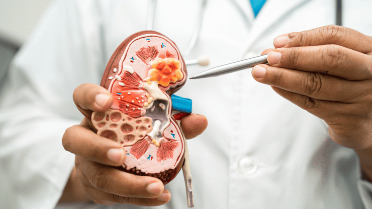 Chronic Kidney Disease nclex review nursing students