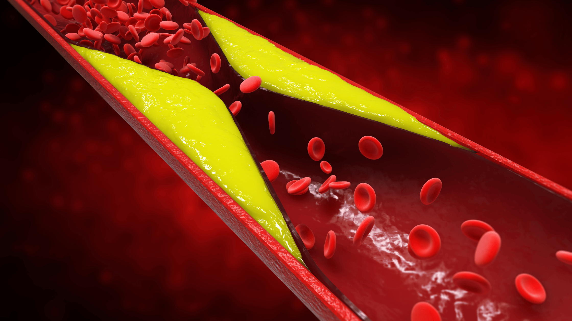 Coronary Artery Disease nursing case study
