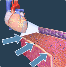 Endocarditis