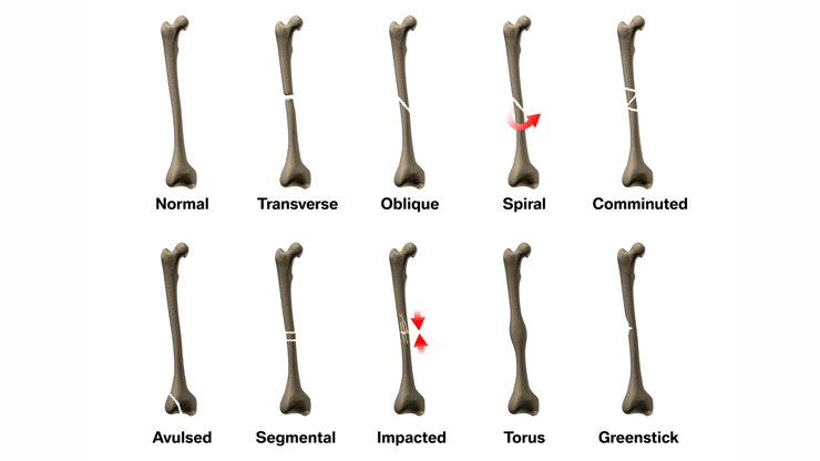 Fractures nclex prep