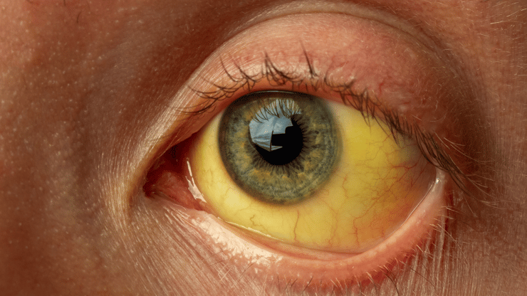 Hepatitis nclex prep