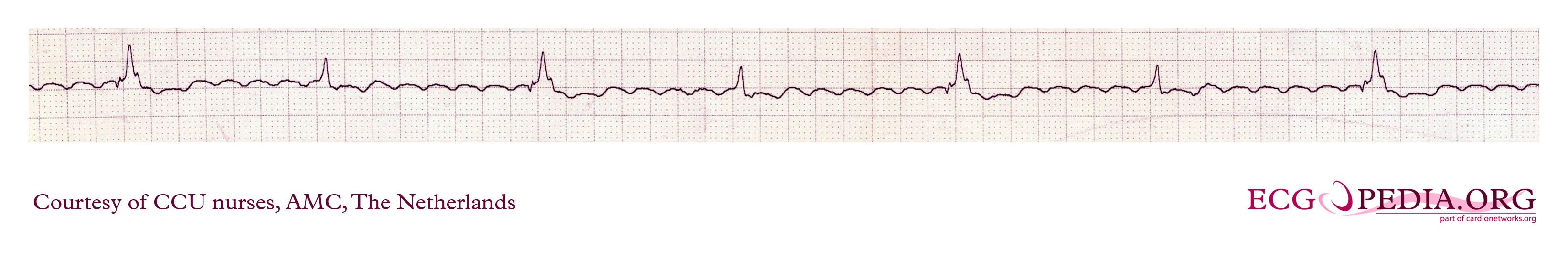 Atrial Flutter