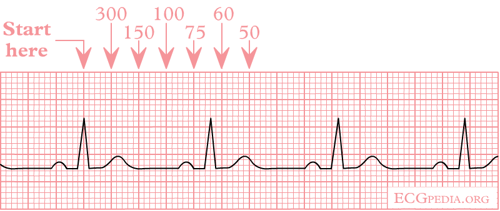 ekg normal sinus rhythm drawing nurse