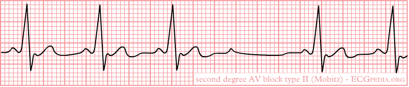2nd degree type 2 mobitz