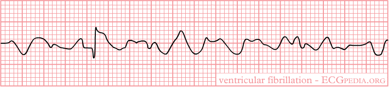 VFib Ventricular Fibrillation
