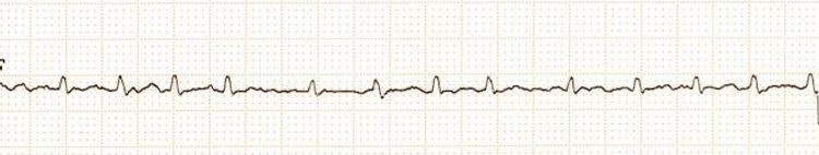Atrial Fibrillation Afib