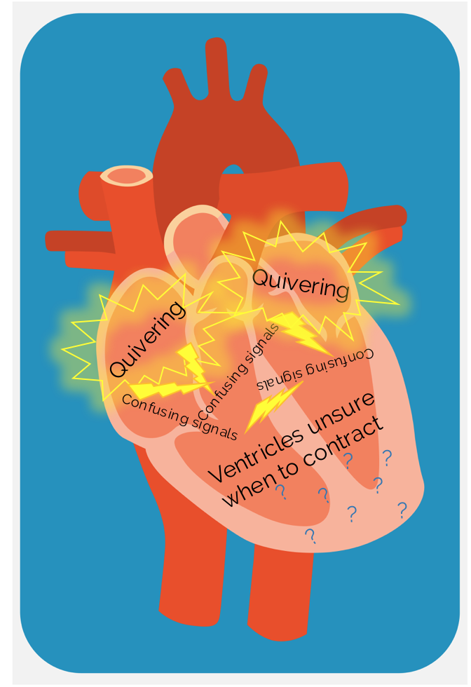 Afib heart