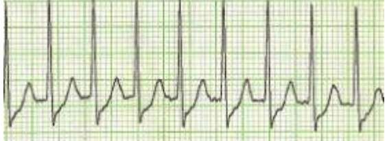 PSVT SVT
