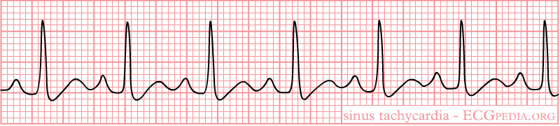 Sinus Tachycardia