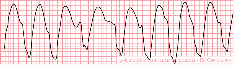 Ventricular Tachycardia VTach