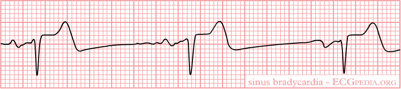 Sinus Bradycardia