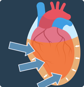 Myocarditus Location