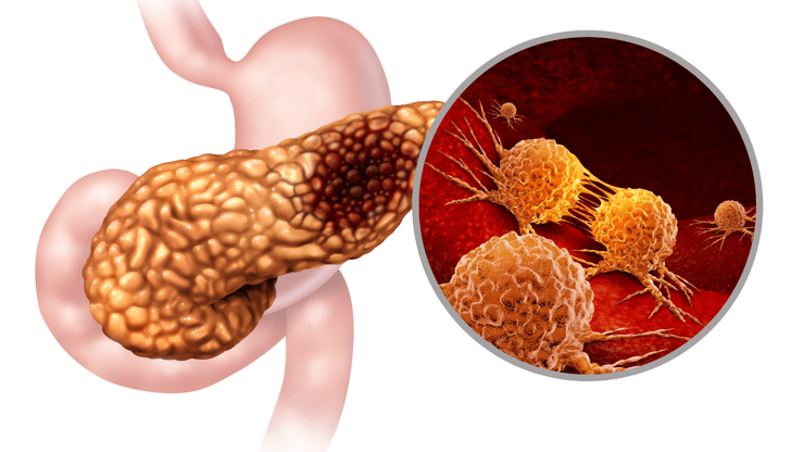 Pancreatitis nursing case study