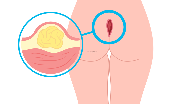 Pressure Ulcers nursing case study-1