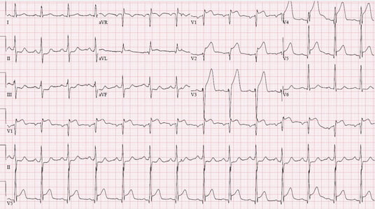 ST_elevation_myocardial_infarction_ECG_(cropped)