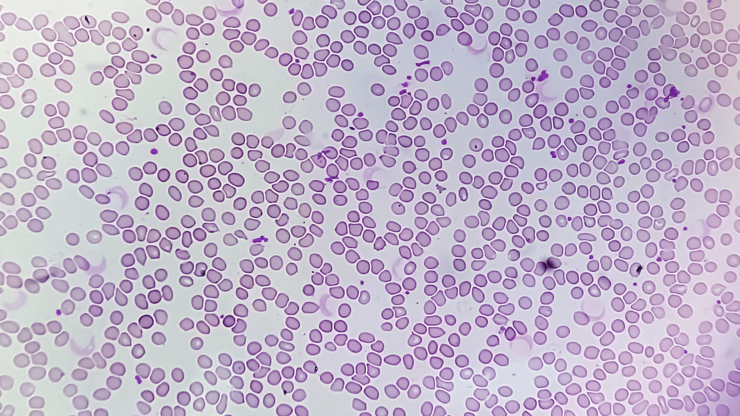 Thrombocytopenia nclex prep