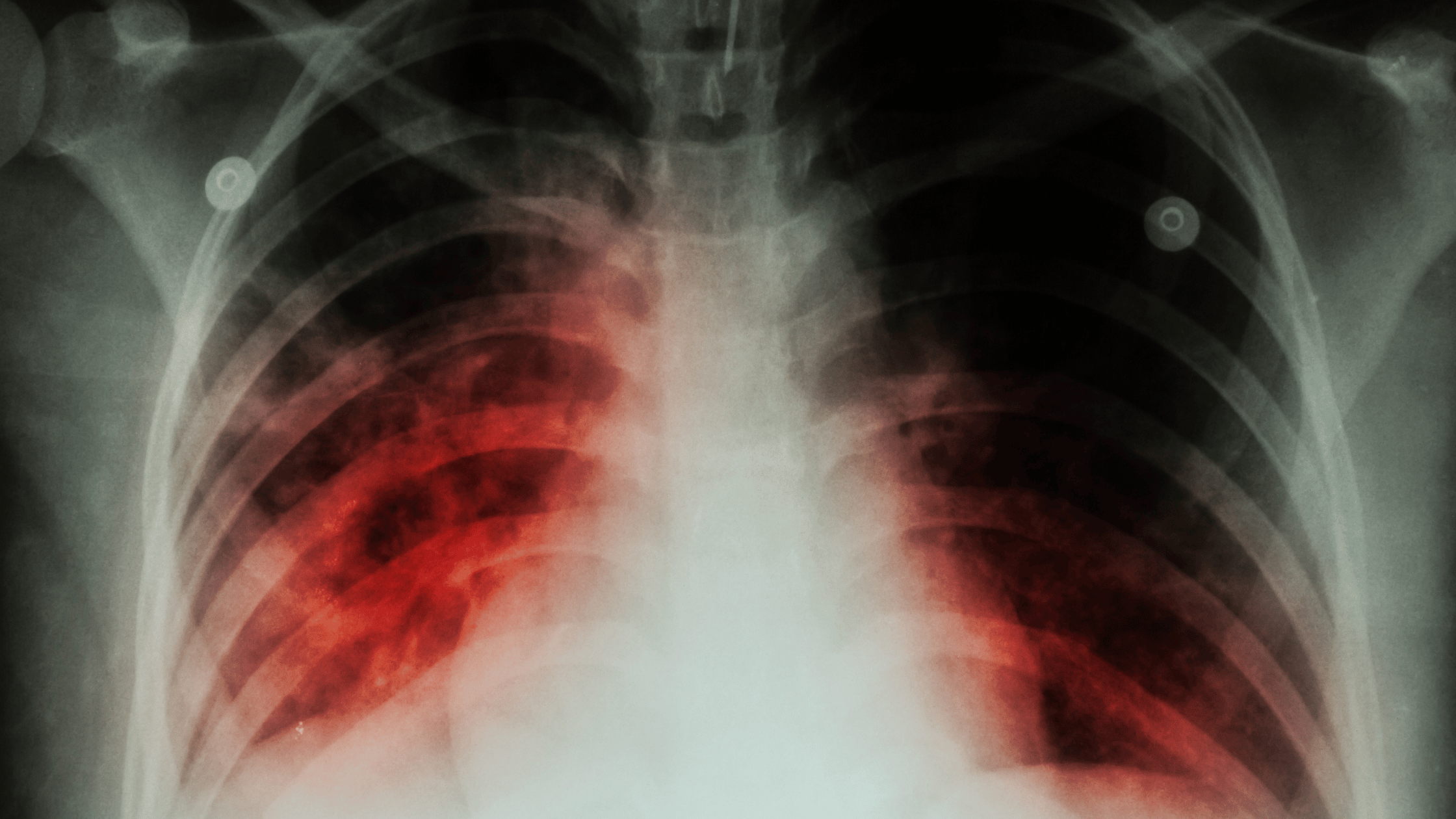Tuberculosis (TB) nclex prep-1