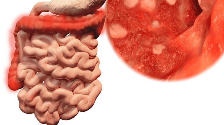 _ulcerative colitis nclex review nursing students