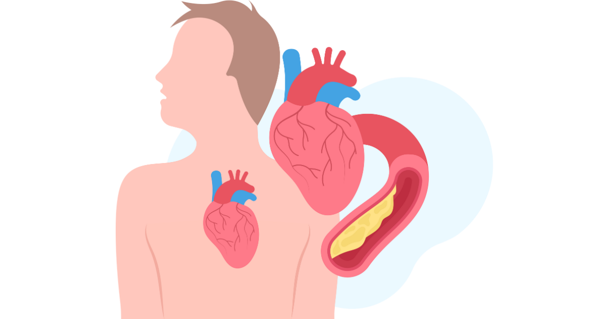 nclex review for angina