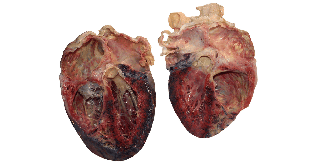 signs of heart failure